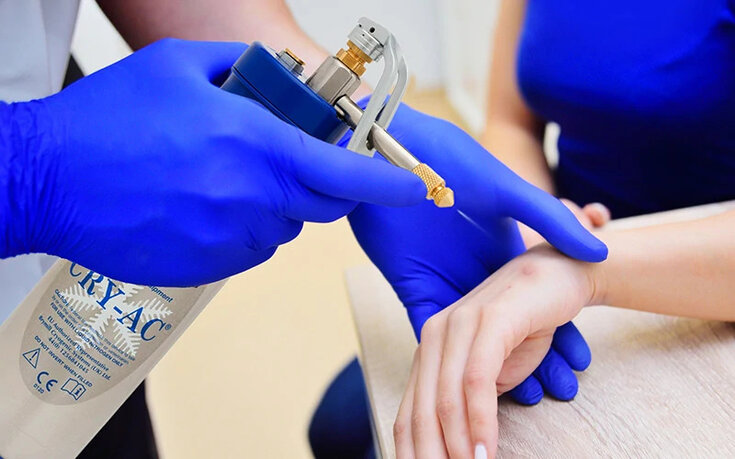 Brymill Cry-Ac® Cryogun | Air Liquide Healthcare